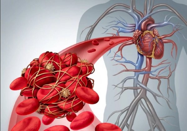 Ученые разработали новый метод для обнаружения тромбов